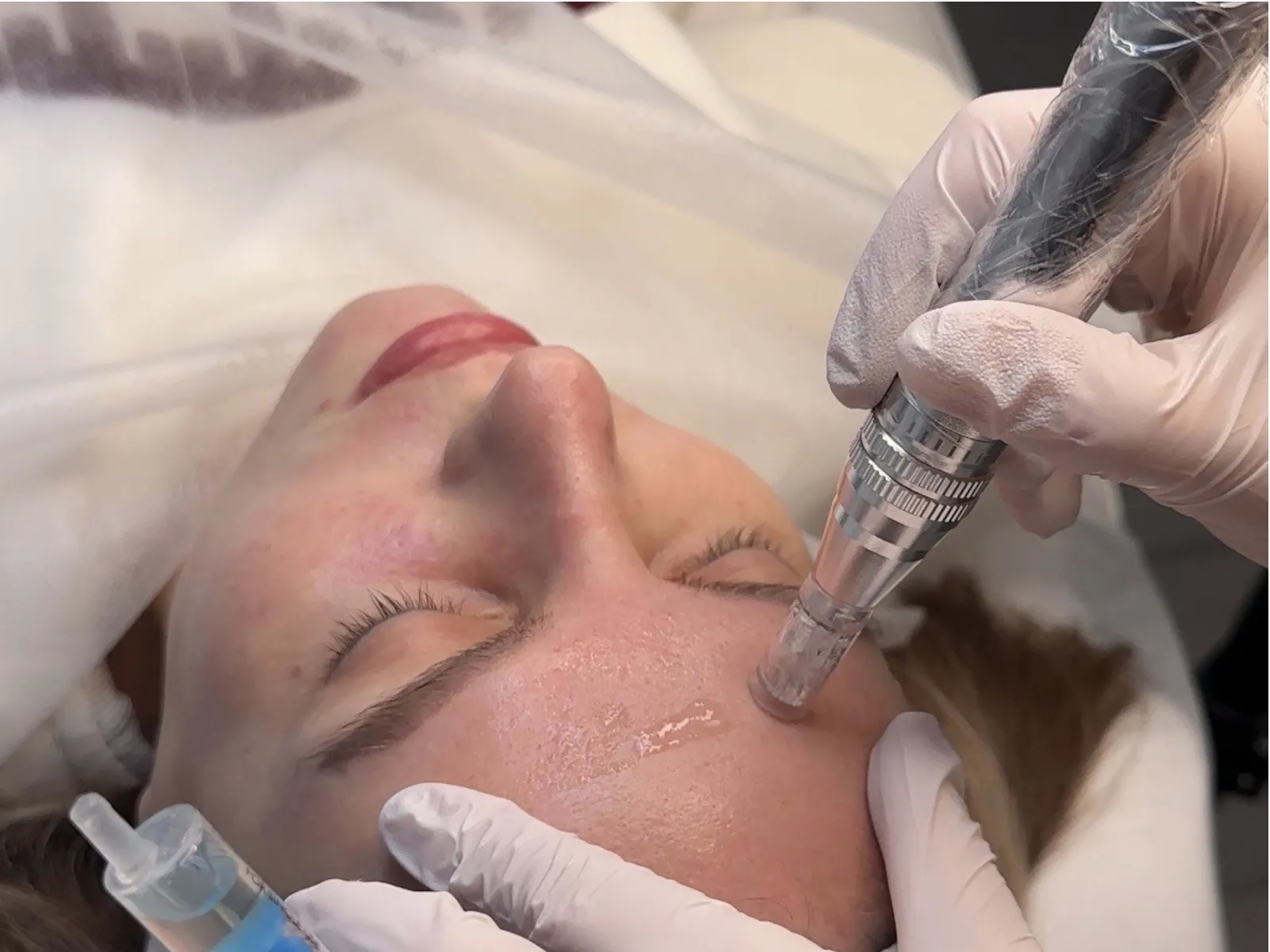 Microneedling — VITA B