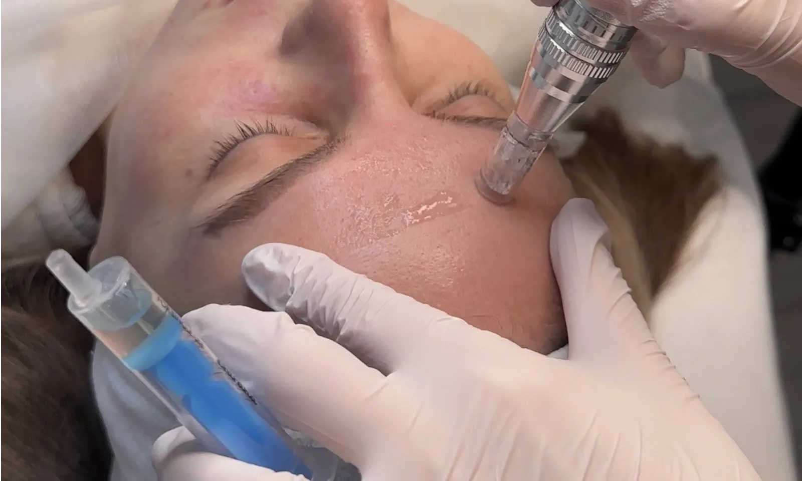 Что такое микронидлинг и кому он подходит?