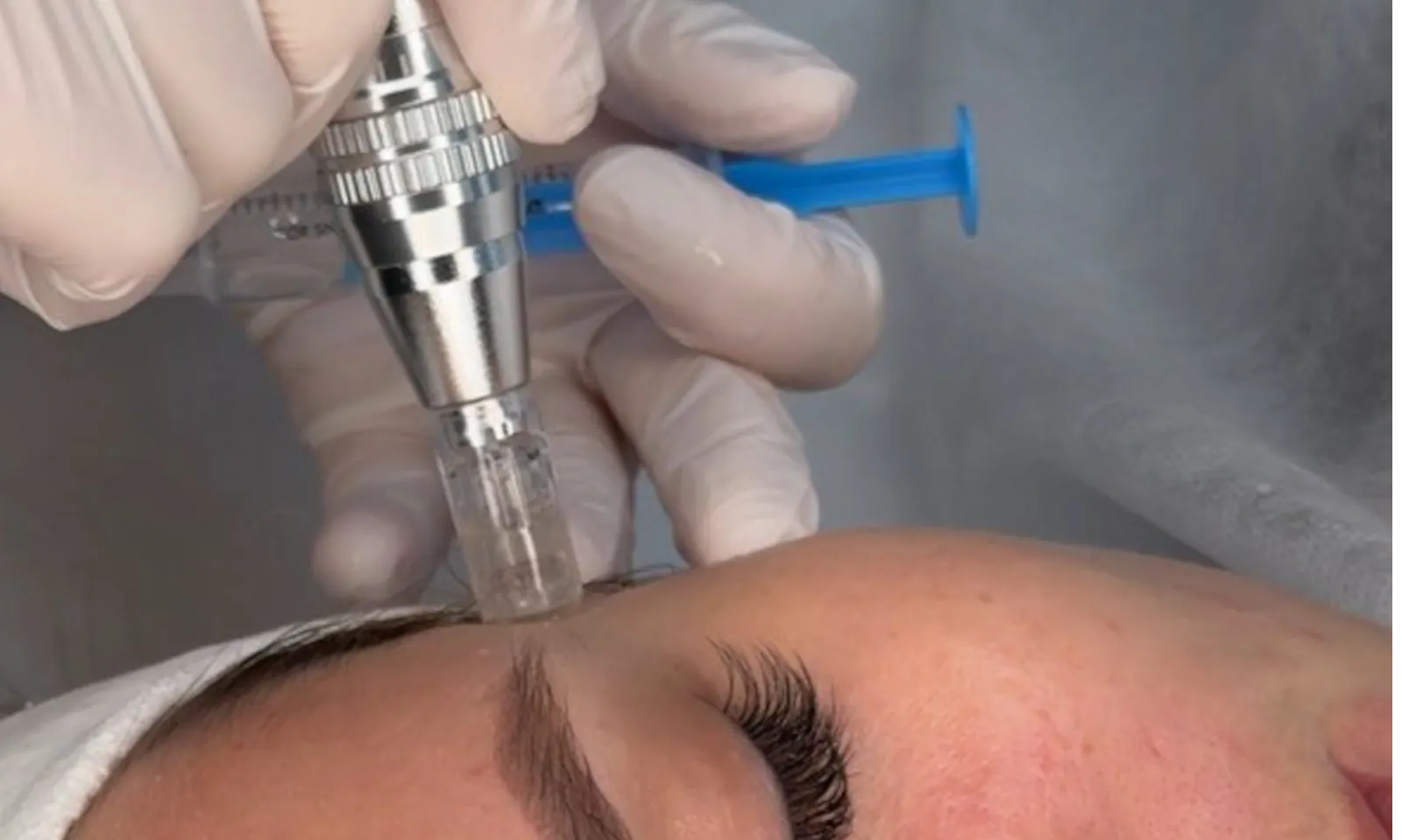 МЕЗОПИЛ: Сила комбинации пилинга и микронидлинга