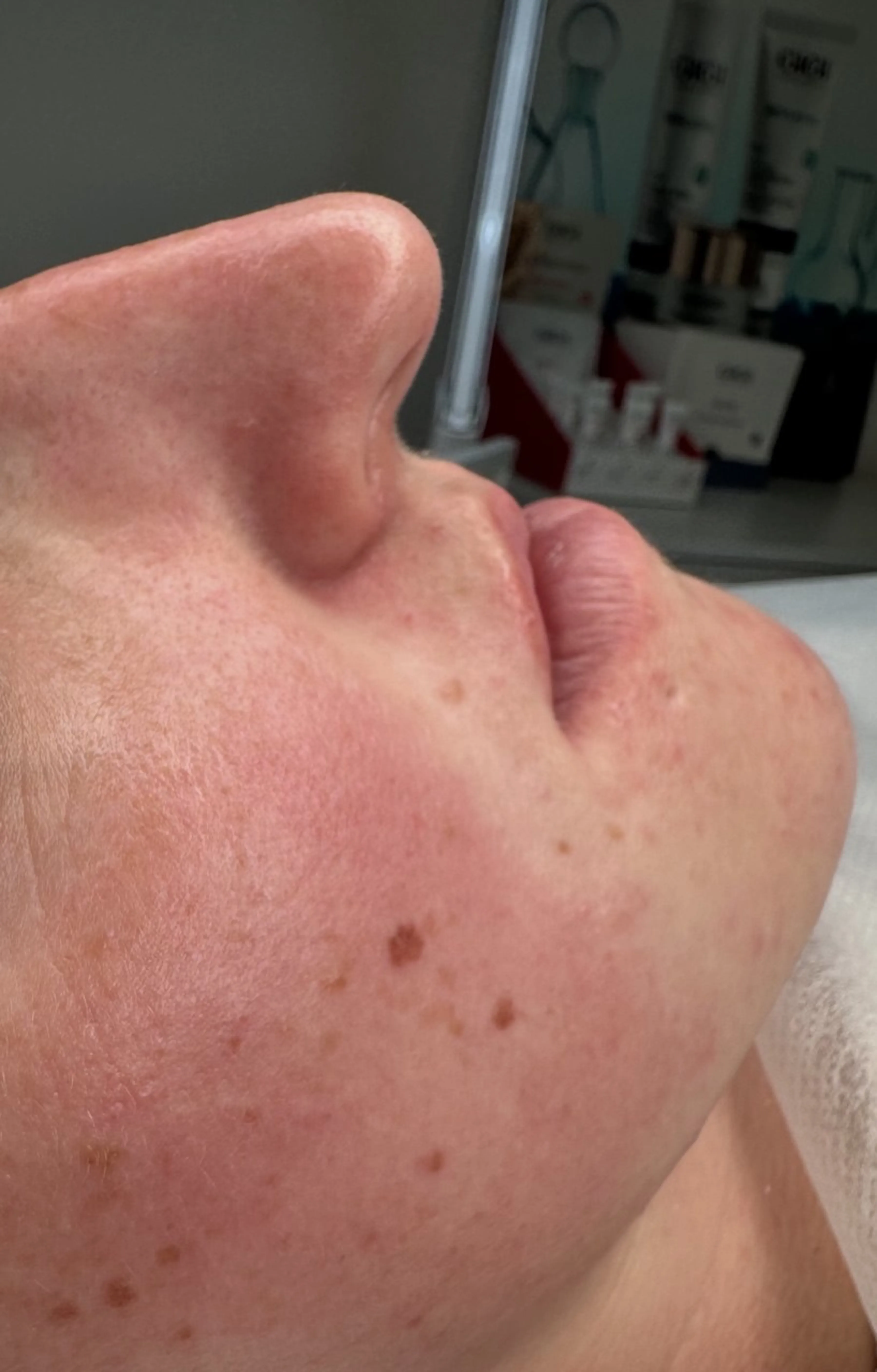 Hloubkové čištění pleti — výsledek po jednom ošetření — Po