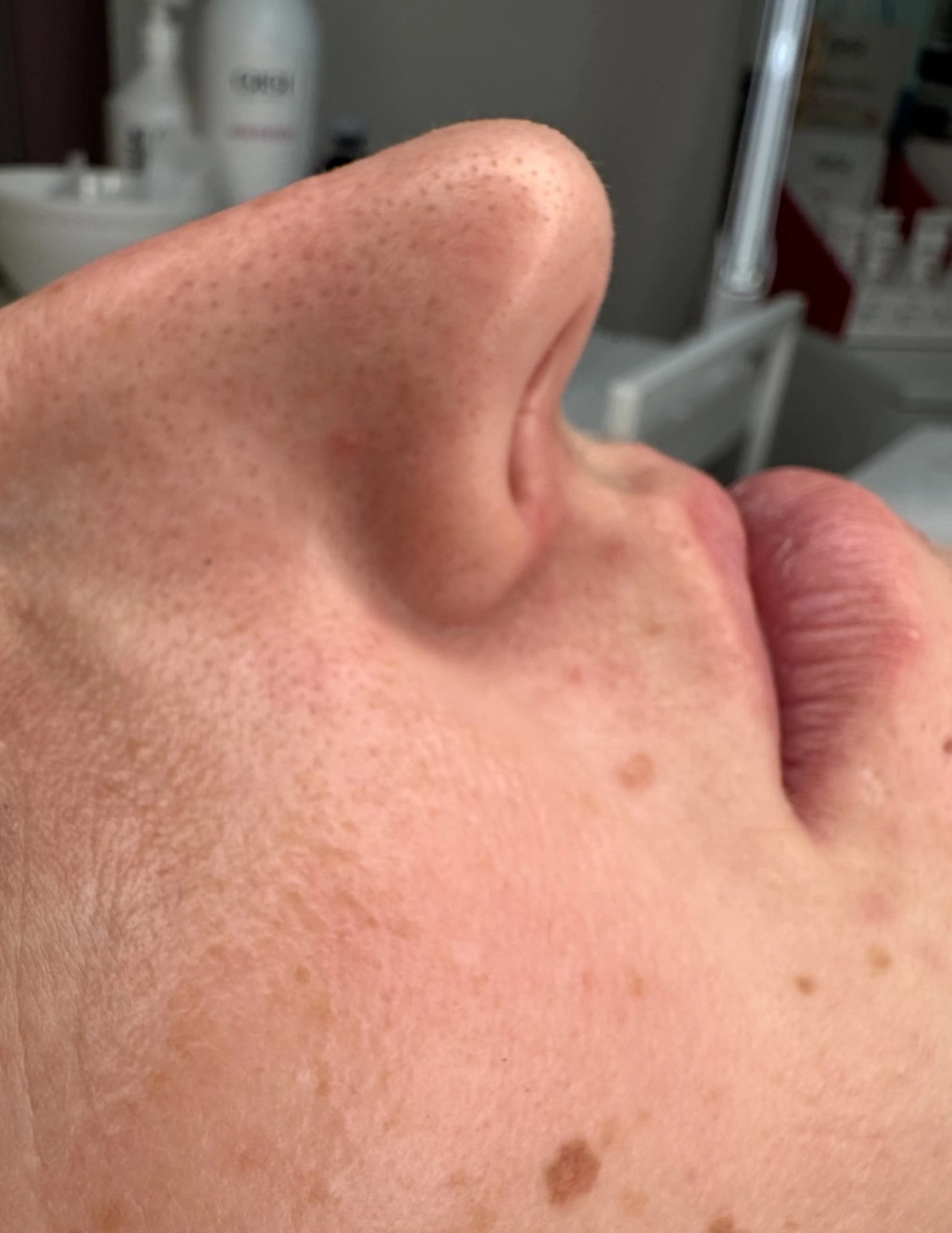 Hloubkové čištění pleti — výsledek po jednom ošetření — Před