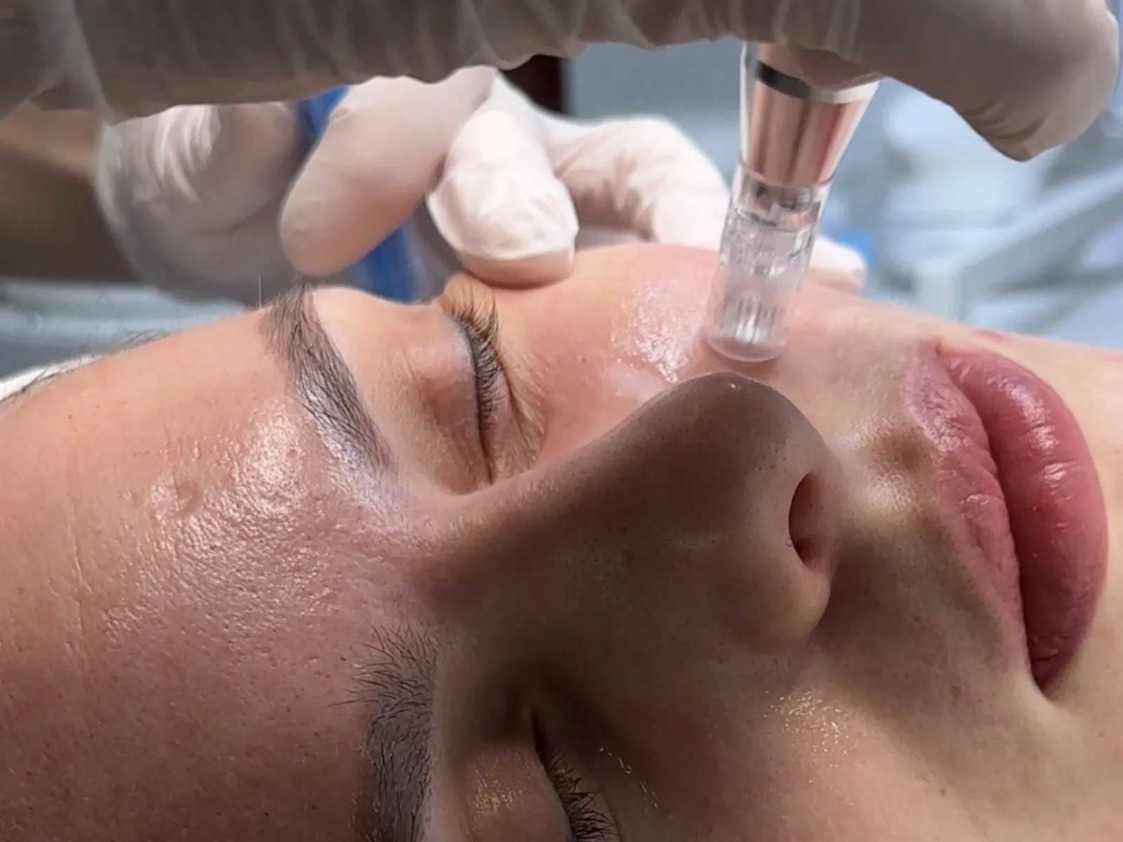 Microneedling — Exosomes